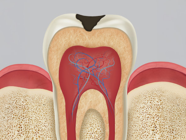충치치료 자연치아살리기