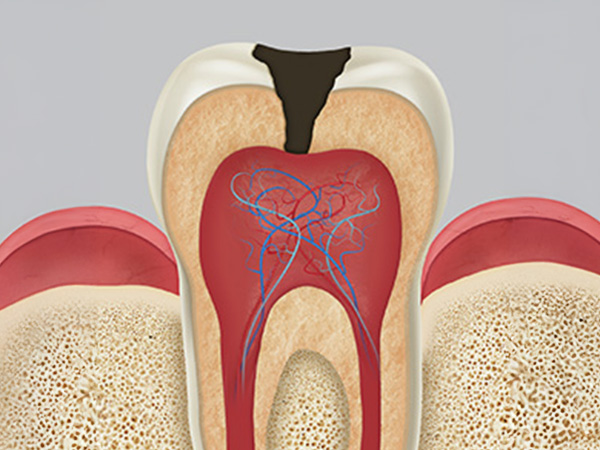 충치치료 자연치아살리기