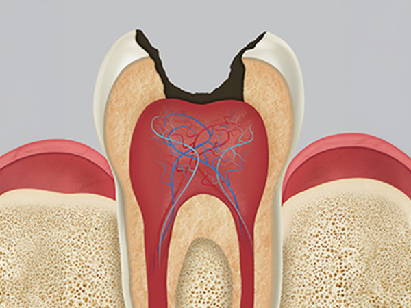 충치치료 자연치아살리기