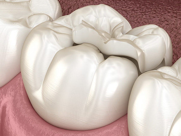 맞춤형 도포마취