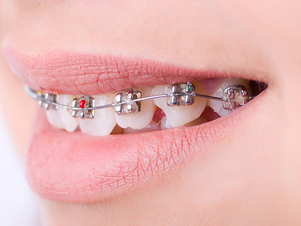 성장기교정 치아교정