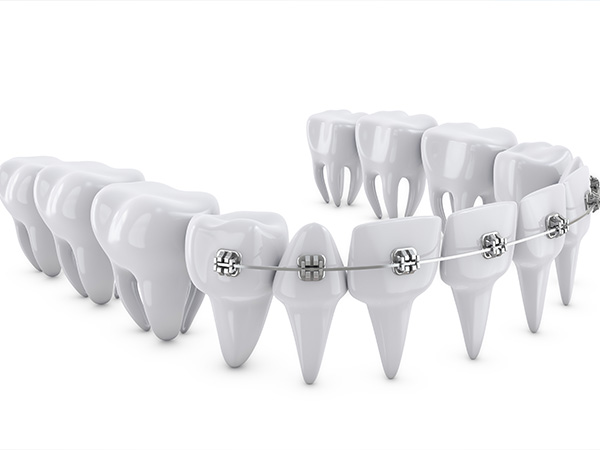 성장기교정 치아교정