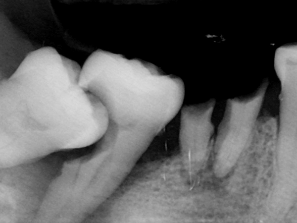 수면 임플란트 수면클리닉