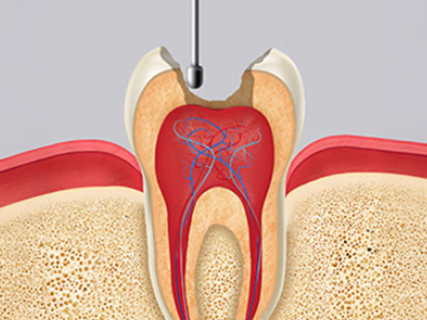 신경치료 자연치아살리기