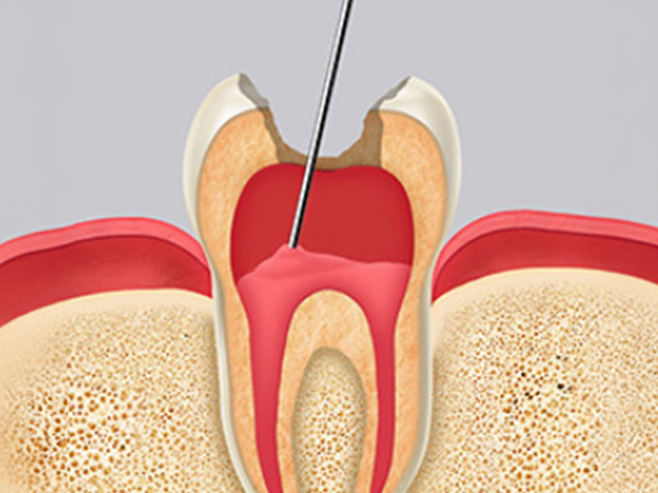 신경치료 자연치아살리기