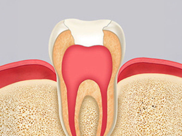 신경치료 자연치아살리기