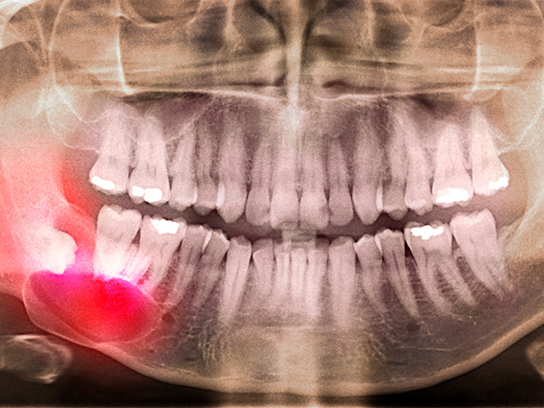 사랑니 악안면외과