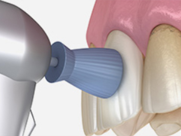 치아미백 심미치료