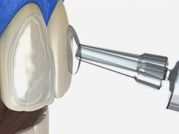치아미백 심미치료