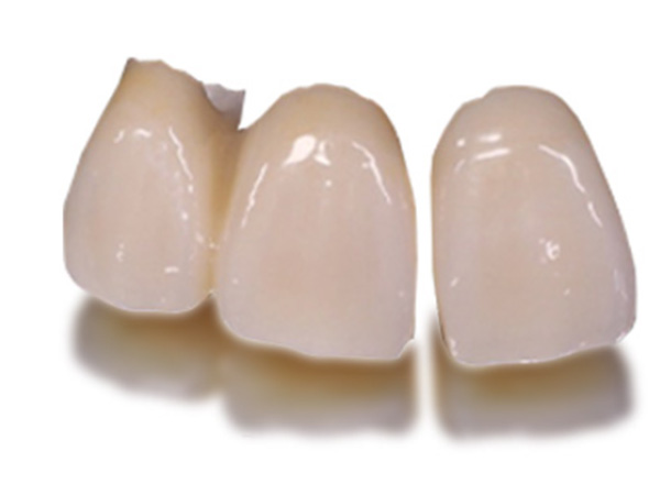 라미네이트 심미치료