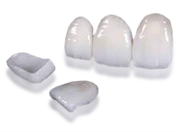 라미네이트 심미치료