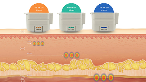 모공,흉터 레이저
