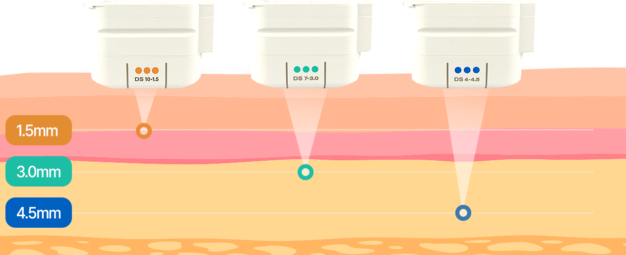 최소식립 전악임플란트 임플란트
