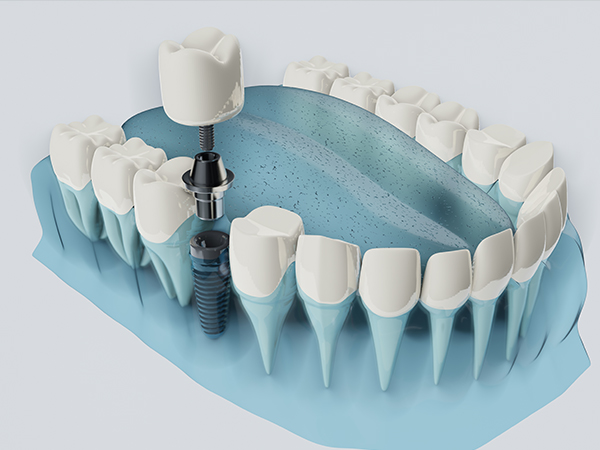최소식립 전악임플란트 임플란트