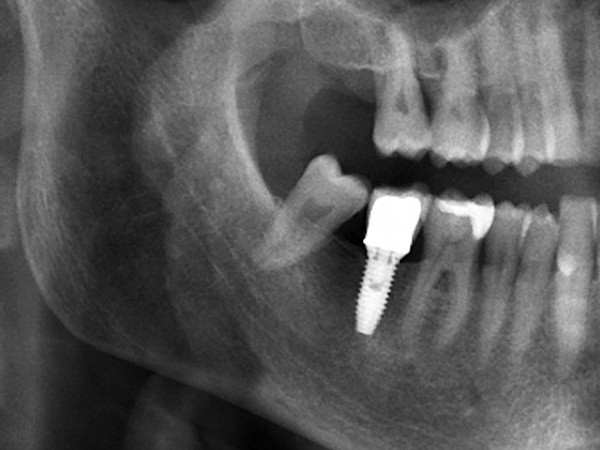무절개 임플란트틀니 임플란트