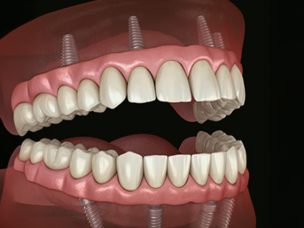 무절개 임플란트틀니 임플란트