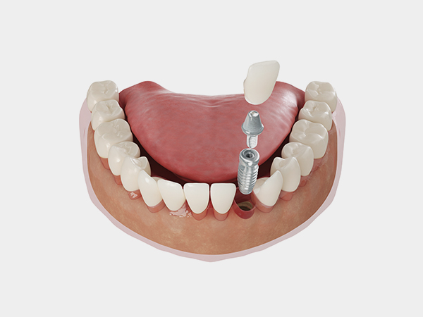 임플란트 살리기와 재수술 임플란트