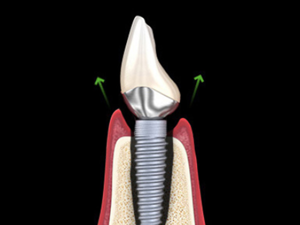 임플란트 살리기와 재수술 임플란트