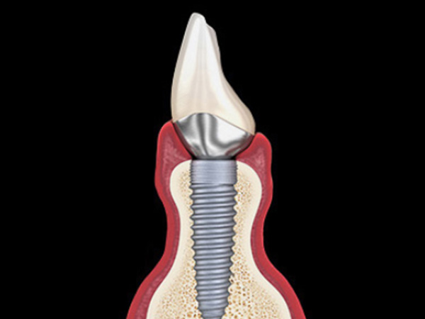 임플란트 살리기와 재수술 임플란트